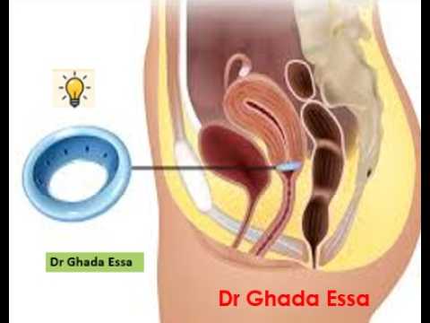 حلقة رفع رحم M